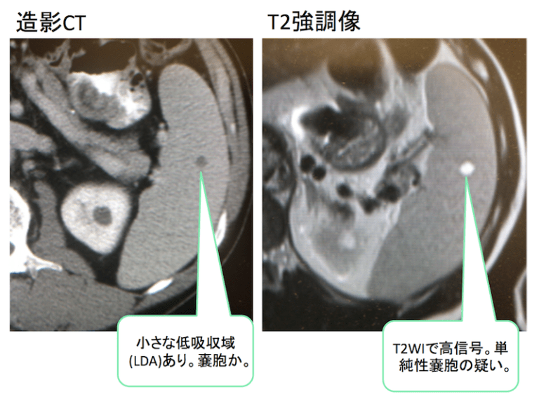 エコーやCTで脾臓の腫瘍を指摘された！鑑別は？症状は？